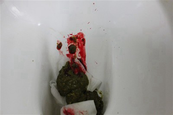 結腸癌症狀 (44) 