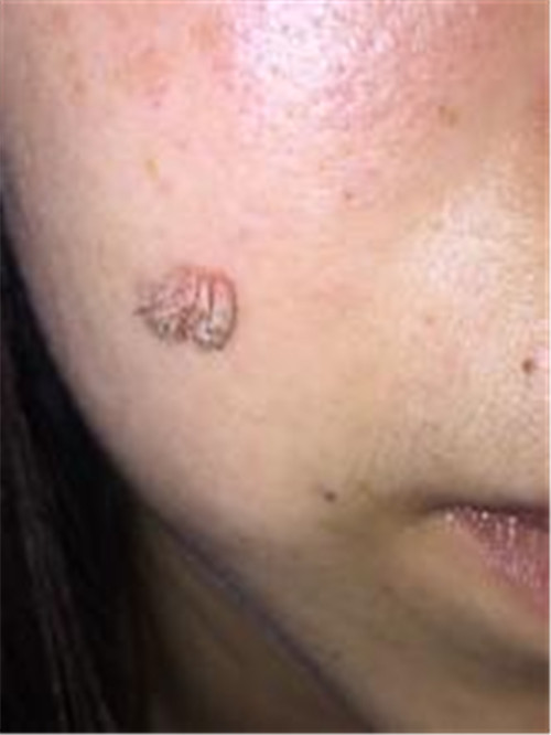 苔蘚狀假性溼疣女