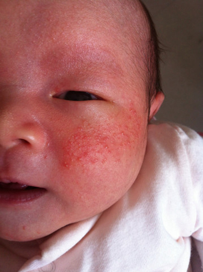 新生兒胎毒的症狀