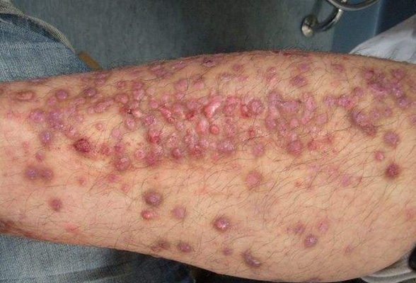 紅斑結節圖 (62) 