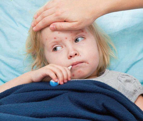 嬰兒蕁麻疹 (40) 