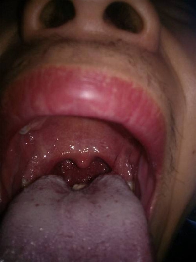 喉部淋巴濾泡增生 (50) 