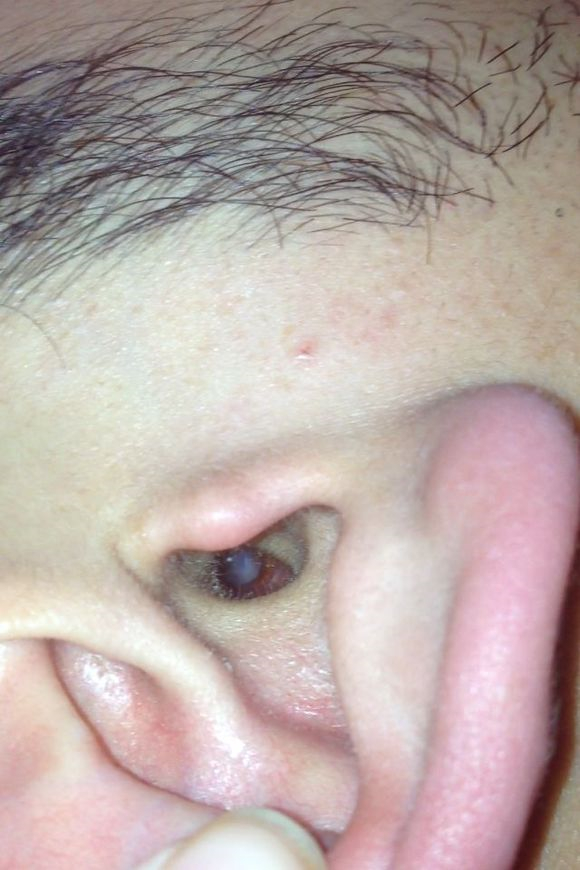 秋季急性中耳炎耳朵