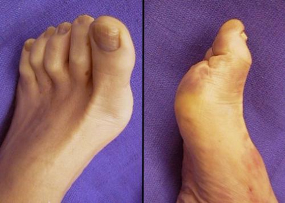 腳骨頭突出 (49) 