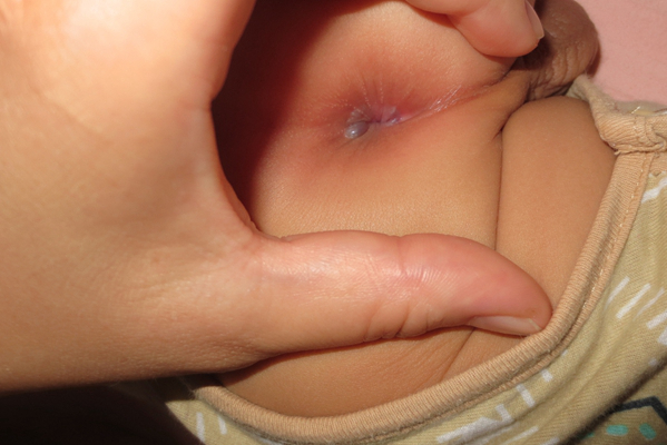 嬰兒肛周膿腫 (32) 