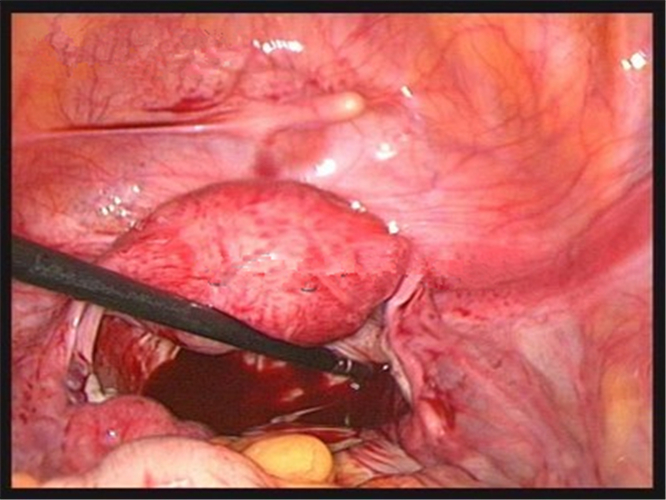 左側輸卵管壺腹部宮外孕 