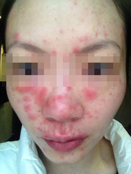 藥物性皮炎症狀的