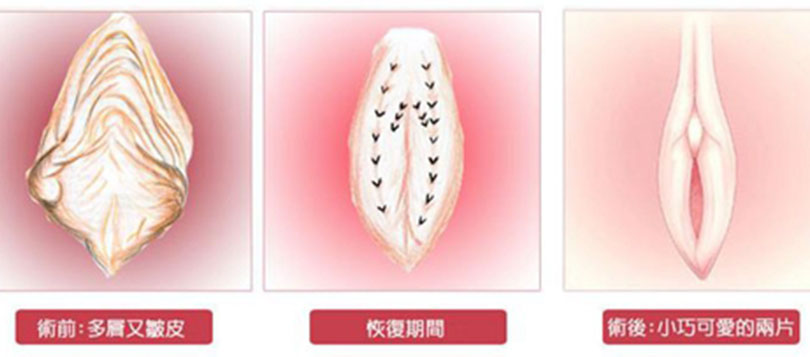 怎樣算是陰唇肥大