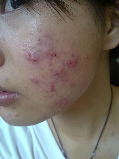 血熱的症狀痘痘