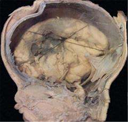 小腦腦萎縮解剖