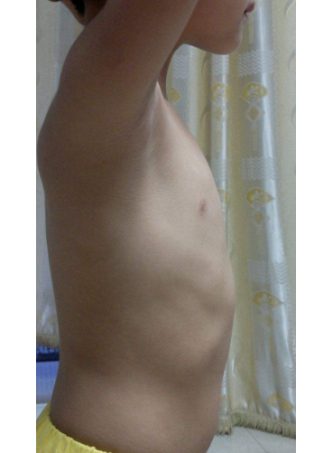 寶寶缺鈣雞胸圖 (50) 