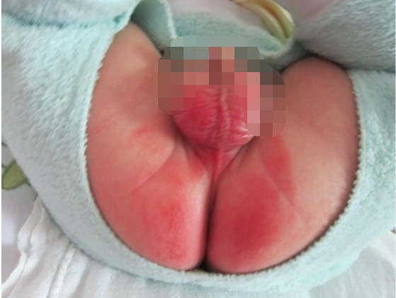 寶寶紅屁屁照片 (54) 