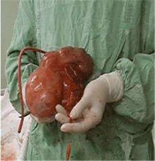 手術切除腎囊腫