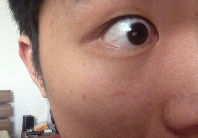 男人臉上長斑的