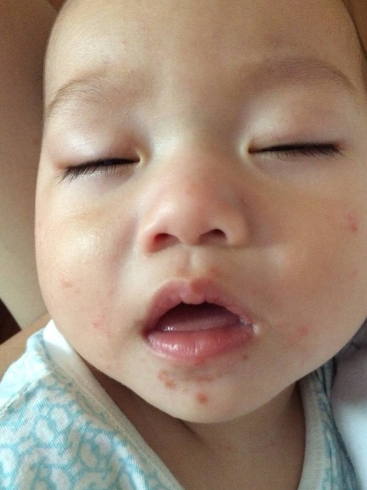 臉上皮膚過敏症狀