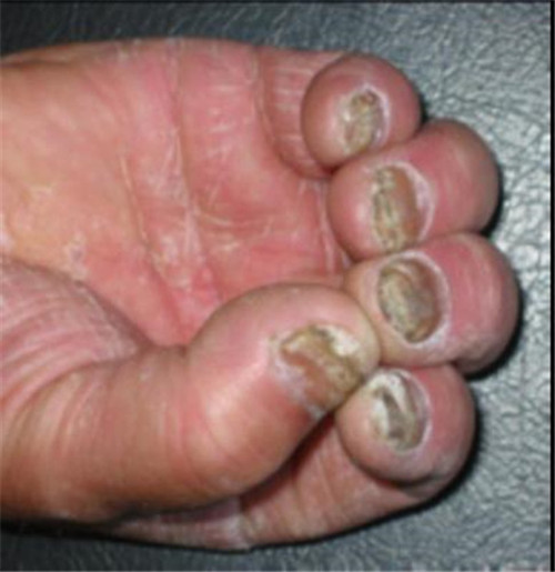 男性白色念珠菌感染 