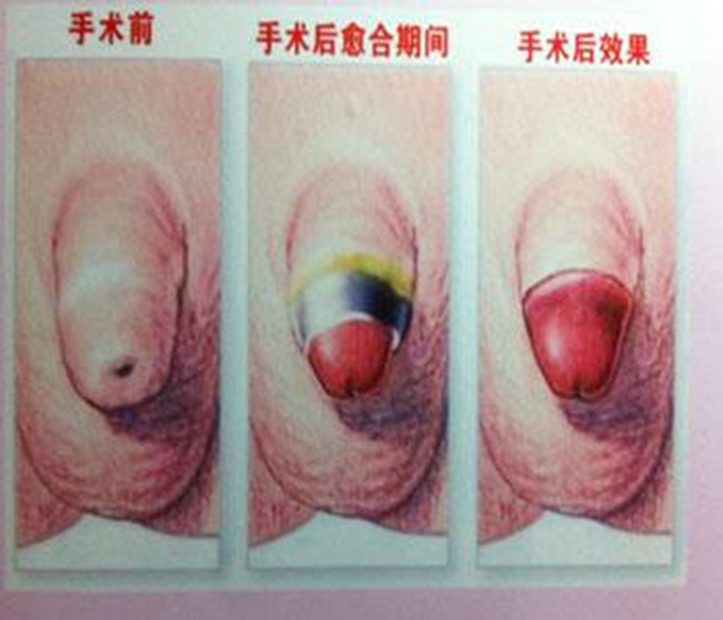 嵌頓包莖是怎麼l了 