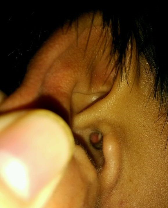 早期男性急性中耳炎