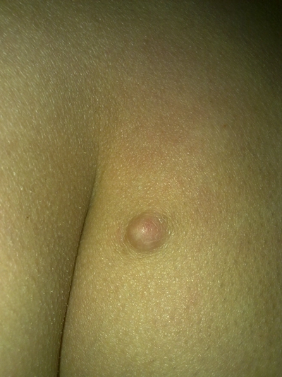 臀部癤子的症狀