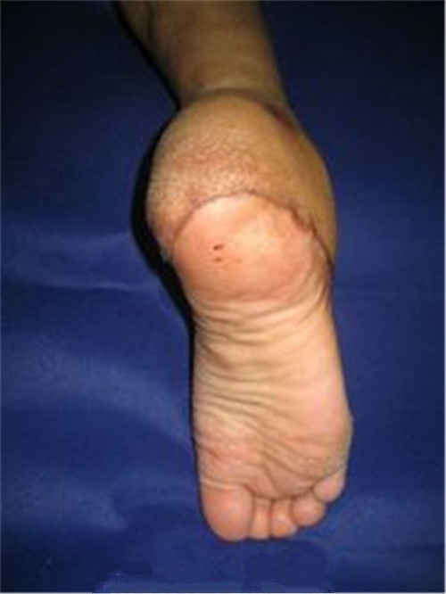 如何治療骨髓炎腳部