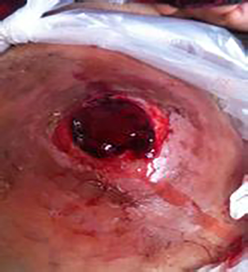 左足底滑膜肉瘤嚴重出血