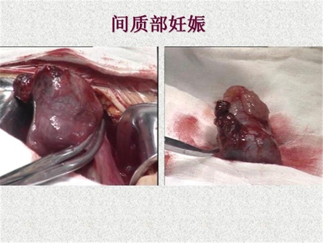 間質部宮外孕