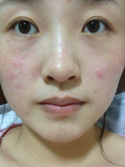 神經性皮炎的治療 (5) 