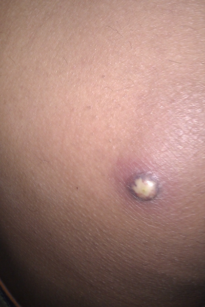 臀部癤子的症狀