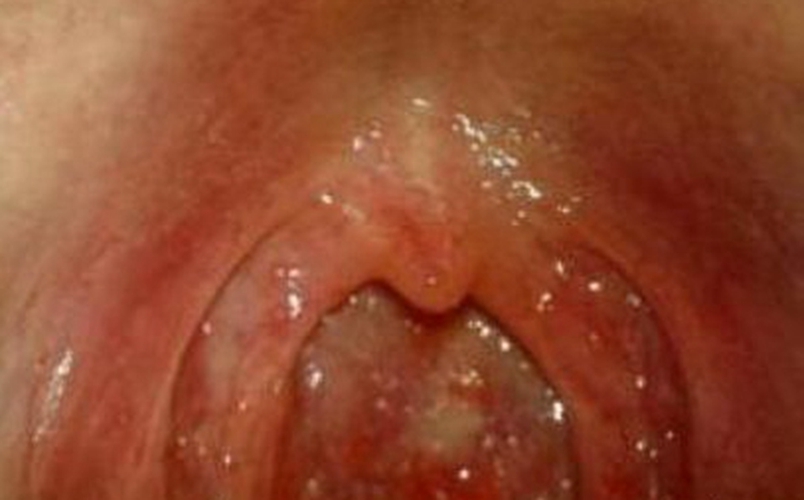 小孩急性咽炎症狀的