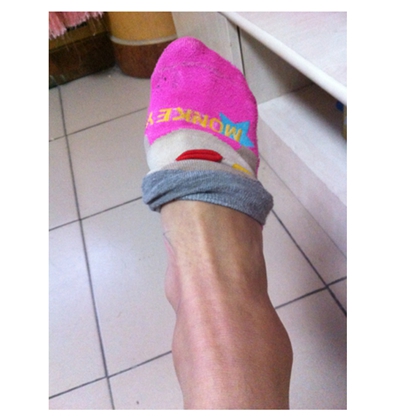 腳骨頭突出 (48) 