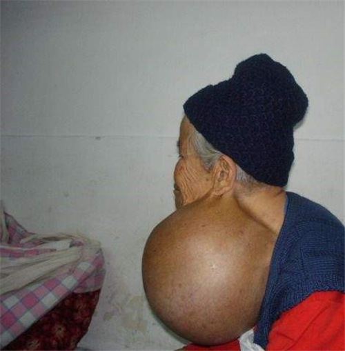 老人巨大甲狀腺結節