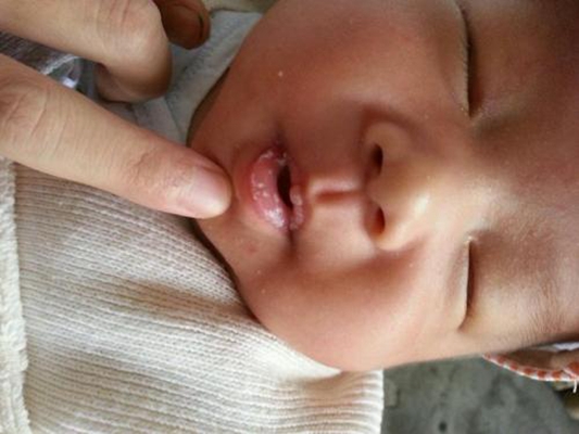 口腔念珠菌感染 (35) 