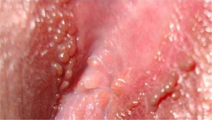 性病性淋巴肉芽腫套圖 (8) 