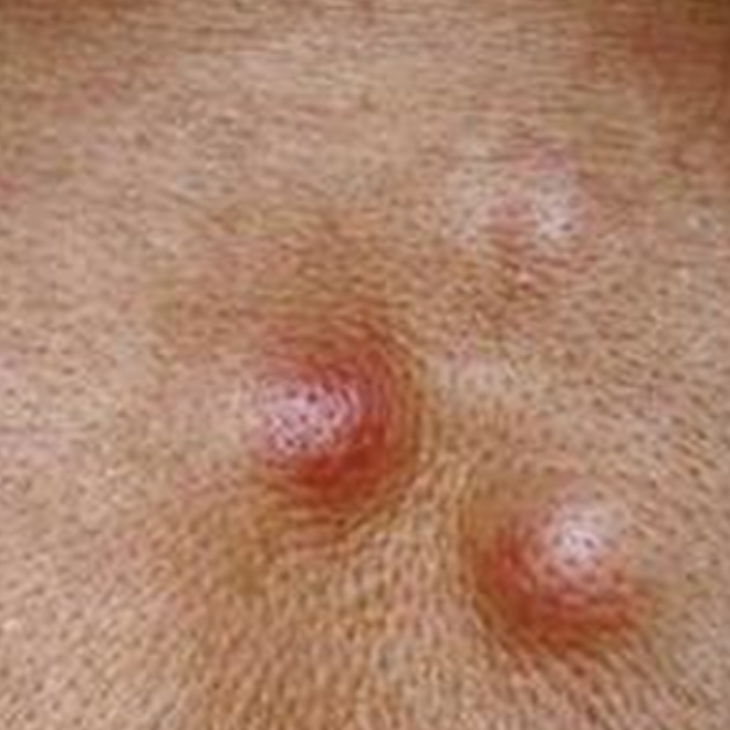 中年下肢淋巴癌早期症狀