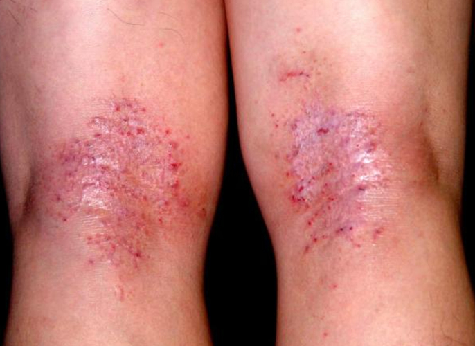 膝蓋後接觸性皮炎