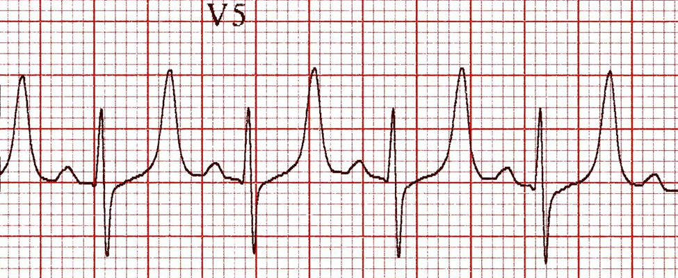 房顫心電圖特點 (8) 