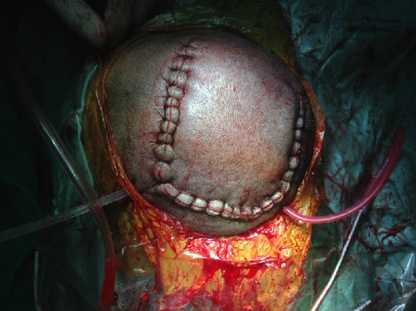 伽瑪刀治腦膜瘤