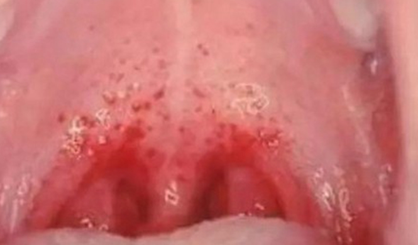 小孩的急性咽炎的症狀