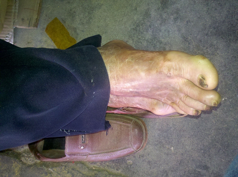 藥物性皮炎腳部疙瘩