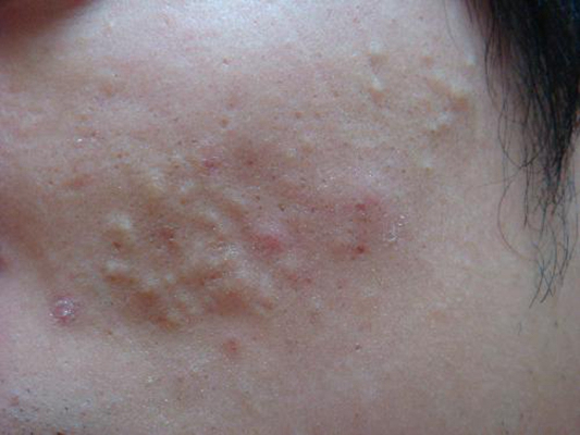 血熱的症狀痘痘