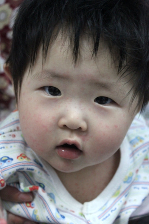 輕微小兒急疹出疹後