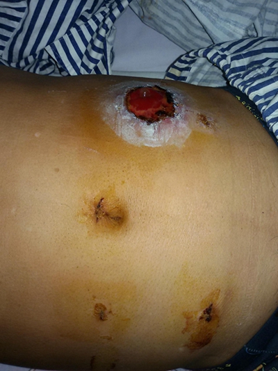 直腸癌晚期症狀 (5) 