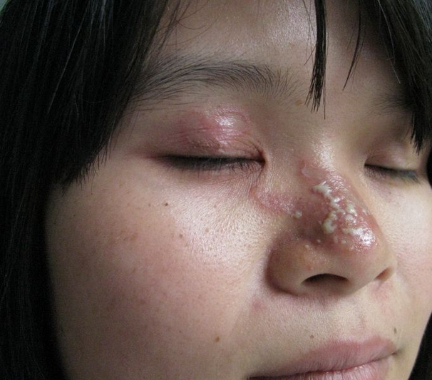 鼻子隱翅蟲皮炎