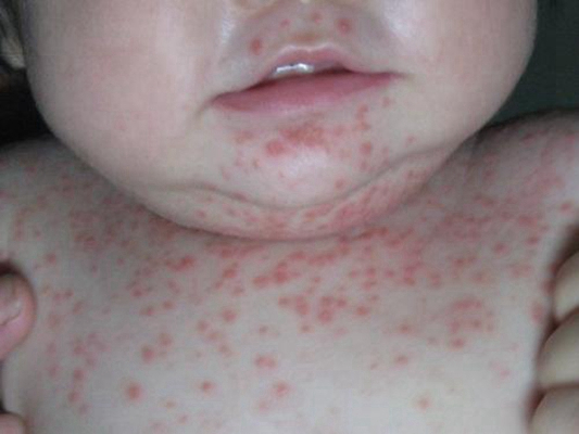嬰兒蕁麻疹 (44) 