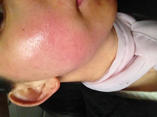 神經性皮炎的治療 (59) 