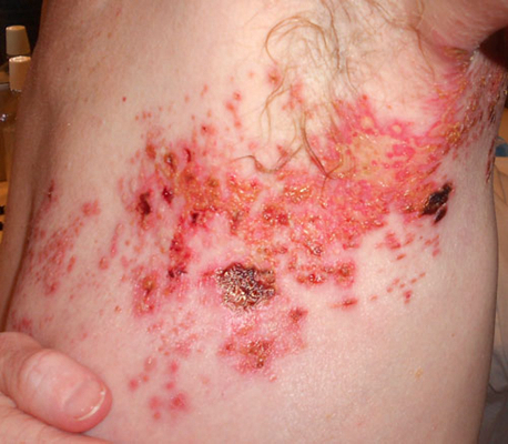 帶狀皰疹樣外觀