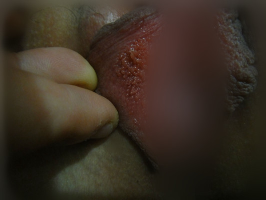 性病性淋巴肉芽腫套圖 (57) 