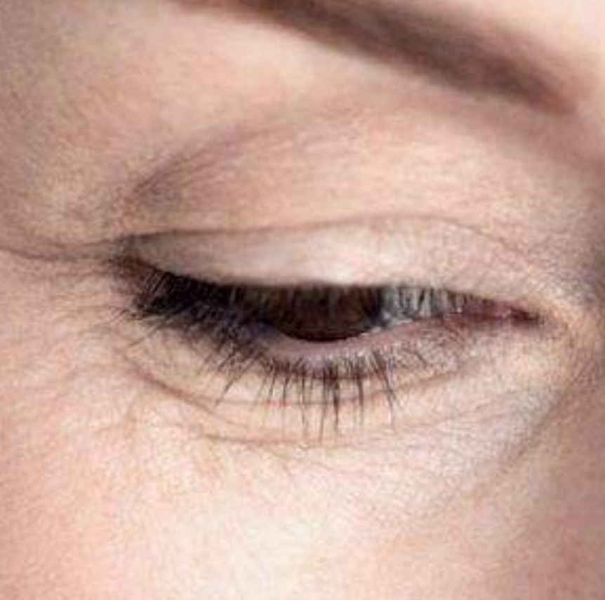 皮膚老化眼部的