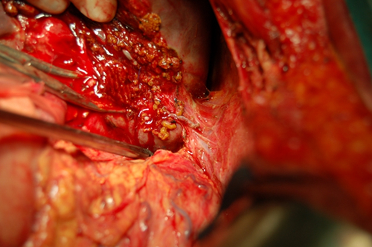 肝外膽管癌初晚期