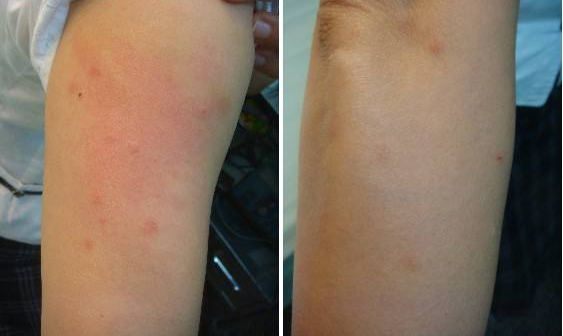 被跳蚤咬的症狀